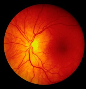 Imagen de fondo de ojo con signos de retinopatía diabética avanzada.